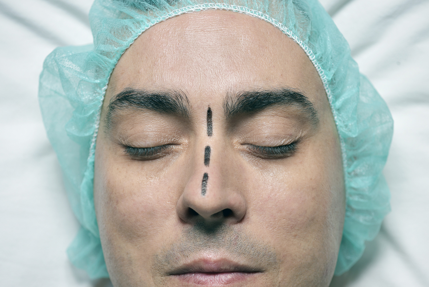Сон нос мужчины. Мужская ринопластика на операционном столе. Турецкий нос.