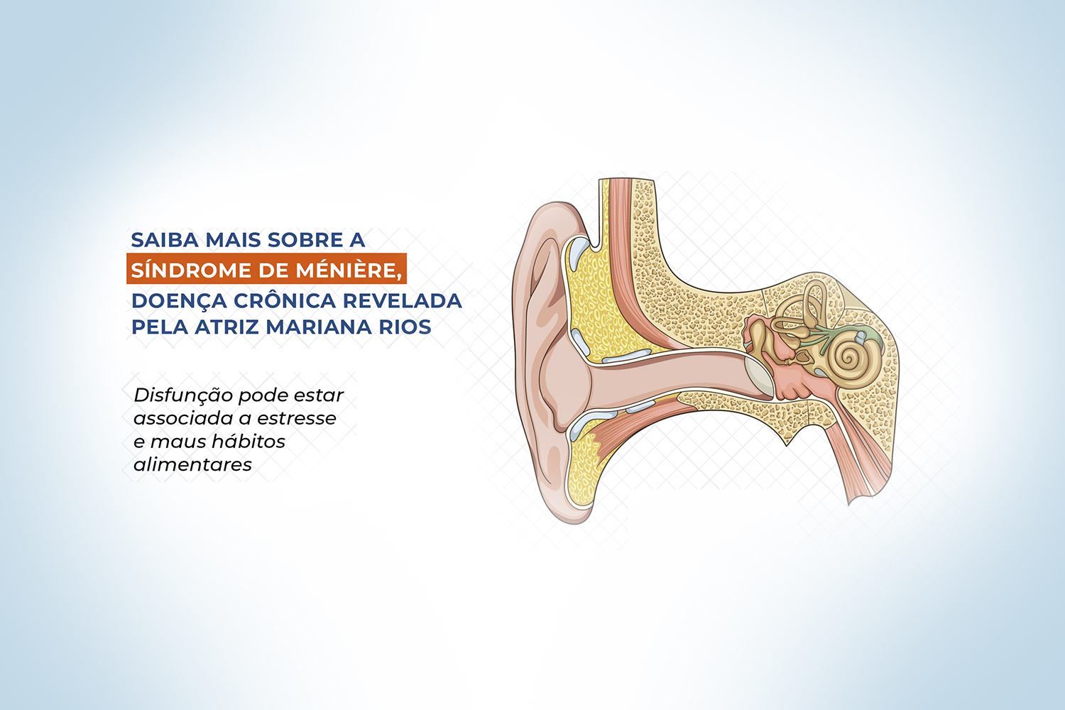 Hidropisia Endolinfatica Síndrome De Ménière: Doença Causou Perda