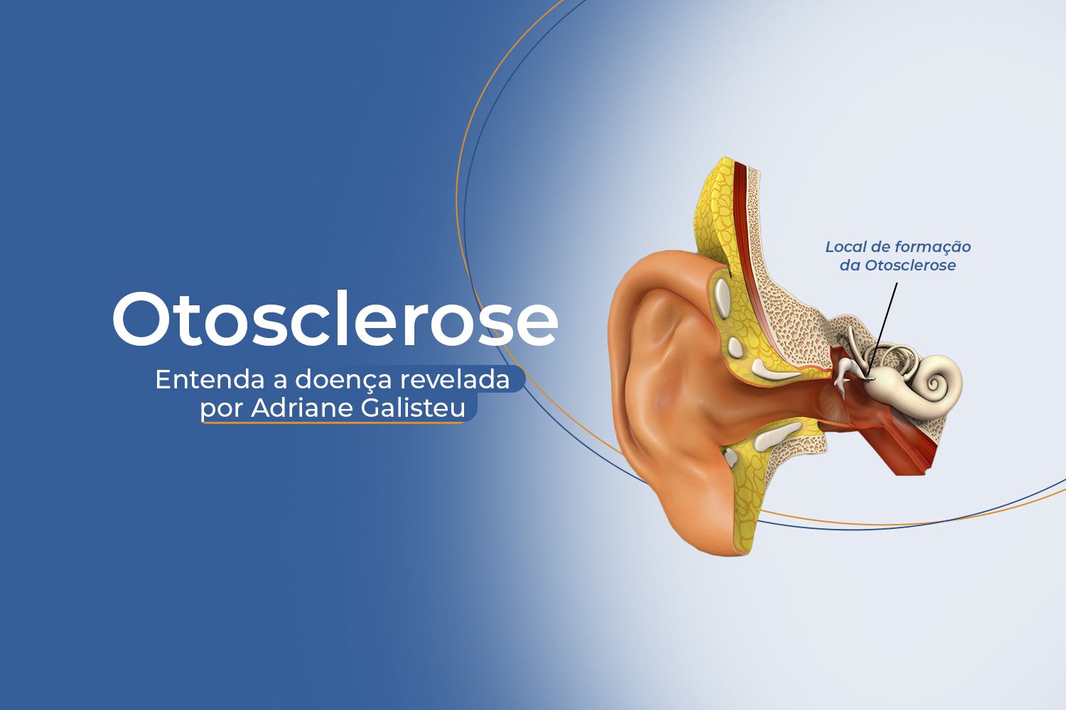Saiba mais sobre a otosclerose, revelada por Adriane Galisteu ...